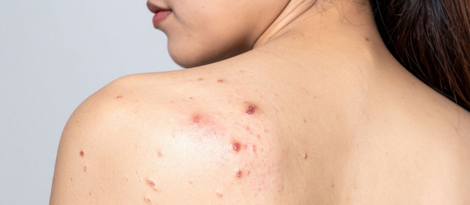 body acne vs face acne treatment