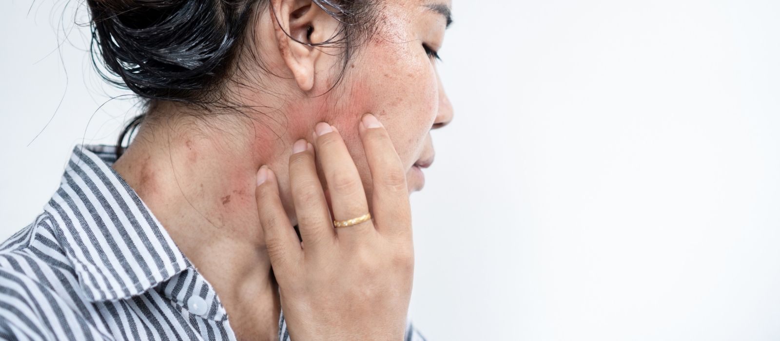 cortisol-effects-on-skin-and-hair