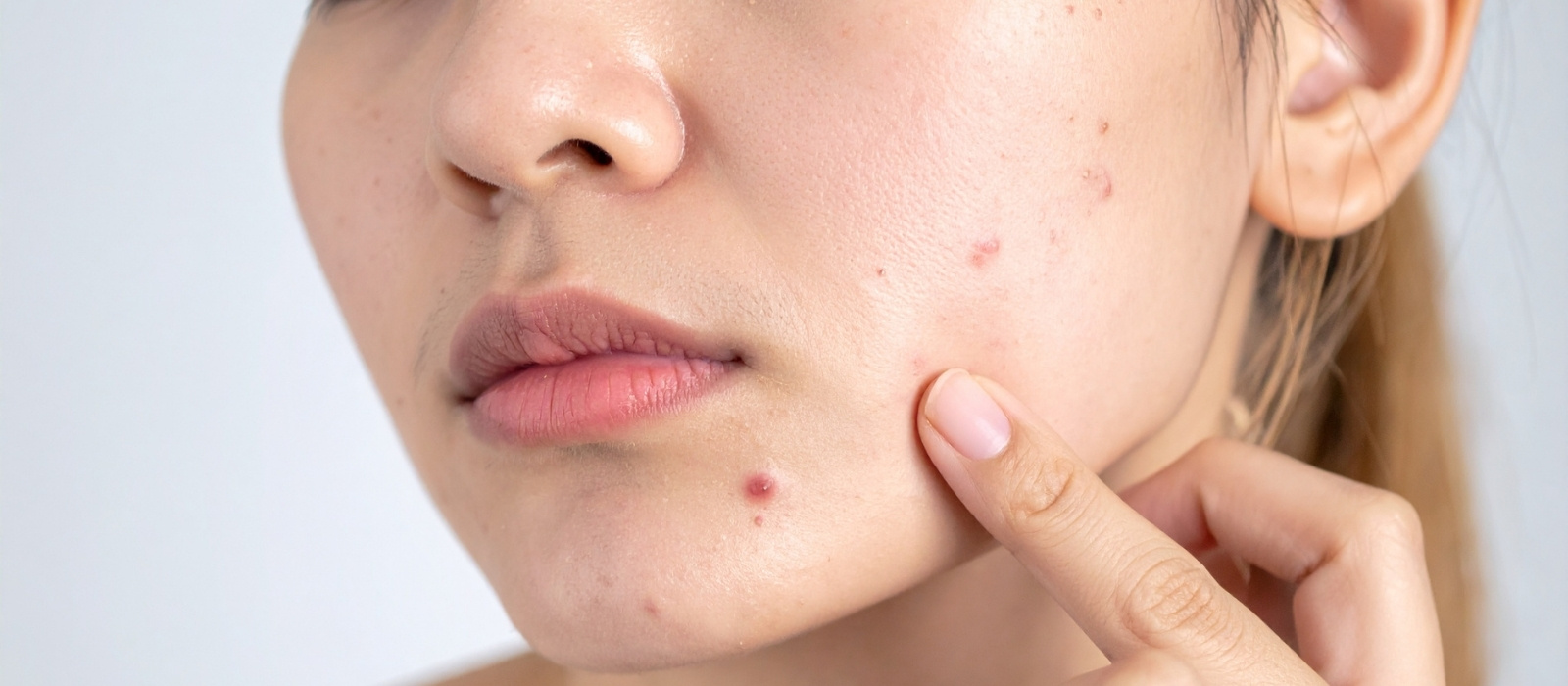 hormonal acne what causes it how to treat it