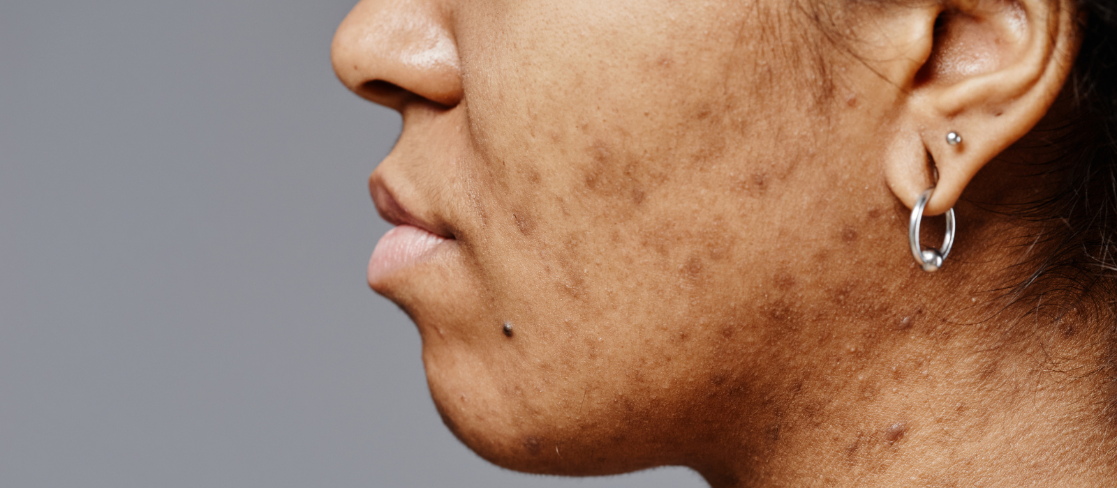 how to get rid of acne scars that actually work