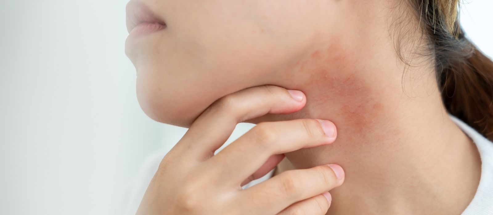 signs you damaged your skin microbiome