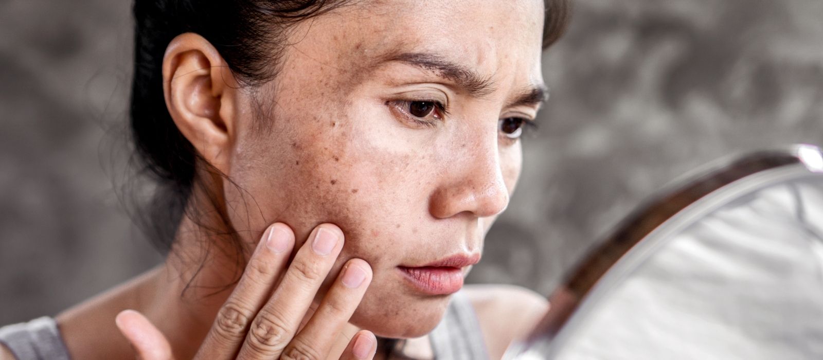what is melasma and how to treat dark spots on face